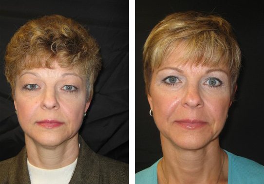 Patient-004-eyelid-lift-upper-and-lower - Upper and Lower Eyelid Lift - Before And After - Fairfax and Manassas VA