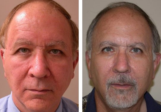 Patient-004527012bfd7e9a-eyelid-lifts-upper - Upper Eyelid Lift - Before And After Photos - Fairfax and Manassas VA