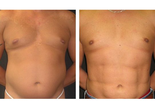 Patient-004a527105d4164ca-abdominal-etching - Abdominal Etching - Before And After - Fairfax and Manassas VA