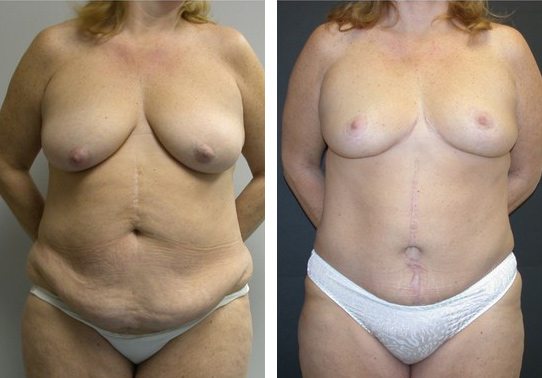 Patient-004a5271069a43dc0-tummy-tuck-abdominoplasty - Tummy Tuck - Before And After - Abdominoplasty - Fairfax and Manassas VA