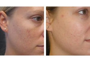 Patient-004b527014d9774ce-dermabrasion - Dermabrasion - Before And After - Fairfax and Manassas VA