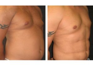 Patient-004b527105d4934ea-abdominal-etching - Abdominal Etching - Before And After - Fairfax and Manassas VA