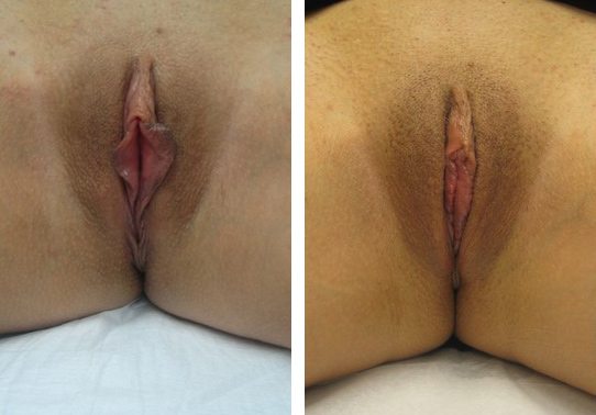 Patient-00552710a72f01d7-labiaplasty - Labiaplasty - Before And After - Fairfax and Manassas VA
