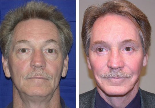 Patient-005a52701380b5e0b-facelift - Facelift - Before And After Photos - Fairfax and Manassas VA
