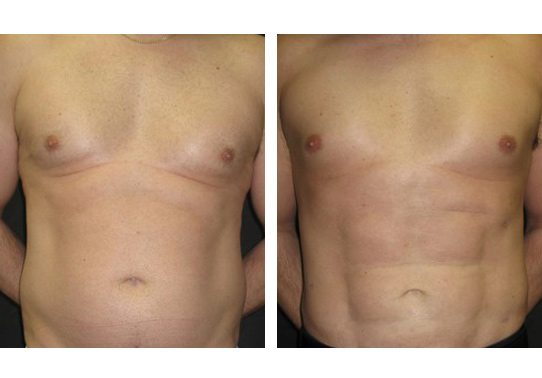 Patient-005a527105d51555c-abdominal-etching - Abdominal Etching - Before And After - Fairfax and Manassas VA