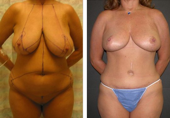 Patient-005a5271069b5c491-tummy-tuck-abdominoplasty - Tummy Tuck - Before And After - Abdominoplasty - Fairfax and Manassas VA
