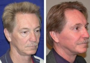 Patient-005b527013814787d-facelift - Facelift - Before And After Photos - Fairfax and Manassas VA