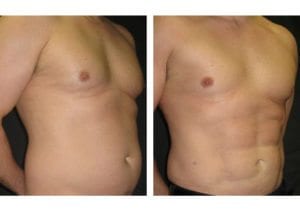 Patient-005b527105d58a86e-abdominal-etching - Abdominal Etching - Before And After - Fairfax and Manassas VA