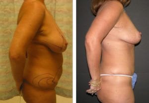 Patient-005b5271069be8e79-tummy-tuck-abdominoplasty - Tummy Tuck - Before And After - Abdominoplasty - Fairfax VA