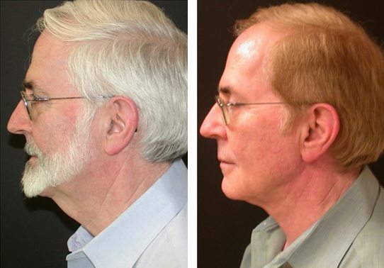 Patient-006-necklift - Neck Lift - Before And After | Fairfax and Manassas VA