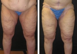 Thigh Lifts Before And After - Fairfax VA