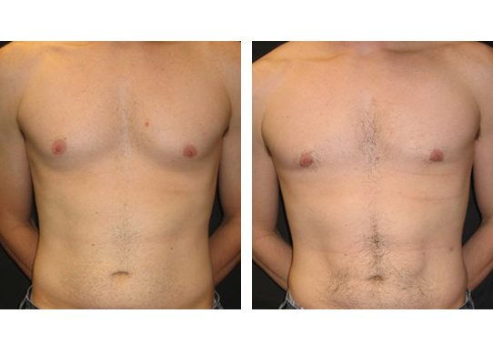 Patient-006a527105d60d87e-abdominal-etching - Abdominal Etching - Before And After - Fairfax and Manassas VA