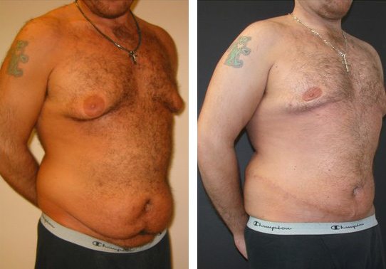 Patient-006b5271069d1ec6d-tummy-tuck-abdominoplasty - Tummy Tuck - Before And After - Abdominoplasty - Fairfax and Manassas VA