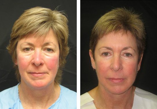 Patient-007-eyelid-lift-upper-and-lower - Upper and Lower Eyelid Lift - Before And After - Fairfax and Manassas VA