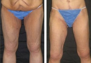 Thigh Lifts Before And After - Fairfax VA