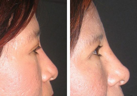 Patient-00752711bbb54678-non-surgical-rhinoplasty - Non-Surgical Rhinoplasty - Before And After | Fairfax and Manassas VA