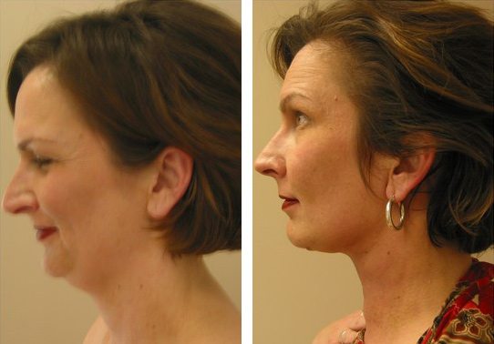 Patient-008-necklift - Neck Lift - Before And After | Fairfax and Manassas VA