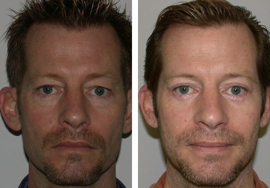 Patient-008527012c17e15a-eyelid-lifts-upper - Upper Eyelid Lift - Before And After Photos - Fairfax and Manassas VA