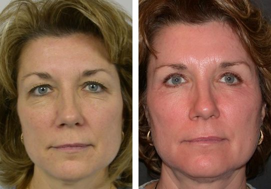 Patient-009527012c20ec1d-eyelid-lifts-upper - Upper Eyelid Lift - Before And After Photos - Fairfax and Manassas VA