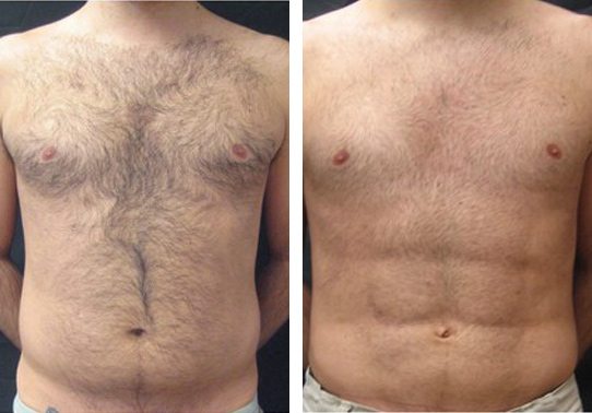 Patient-009a527105d93b75c-abdominal-etching - Abdominal Etching - Before And After - Fairfax and Manassas VA