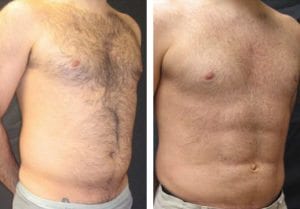 Patient-009b527105da2dcba-abdominal-etching - Abdominal Etching - Before And After - Fairfax and Manassas VA