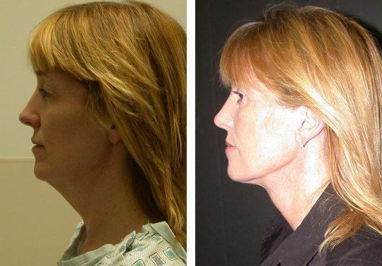 Patient-010-necklift - Neck Lift - Before And After | Fairfax and Manassas VA