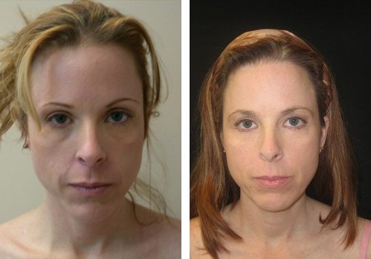 Patient-010a-eyelid-lifts-lower - Lower Eyelid Lift - Before And After - Fairfax and Manassas VA
