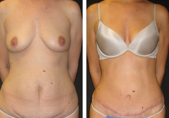 Patient-010a527106a12a887-tummy-tuck-abdominoplasty - Tummy Tuck - Before And After - Abdominoplasty - Fairfax and Manassas VA