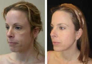 Patient-010b-eyelid-lifts-lower - Lower Eyelid Lift - Before And After - Fairfax and Manassas VA