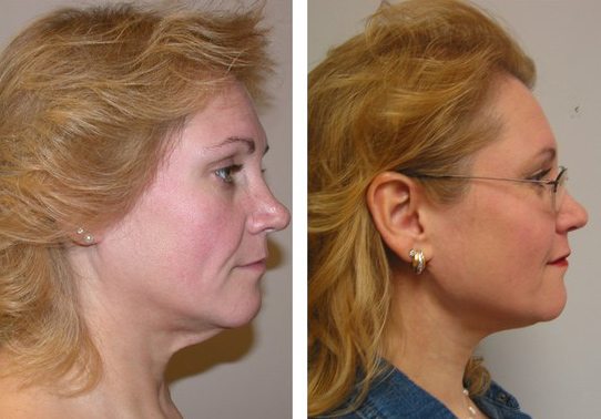 Patient-012-necklift - Neck Lift - Before And After | Fairfax and Manassas VA