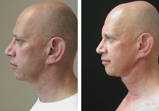 Patient-013-necklift - Neck Lift - Before And After | Fairfax and Manassas VA