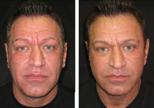 Patient-013527012c436d18-eyelid-lifts-upper - Upper Eyelid Lift - Before And After Photos - Fairfax and Manassas VA