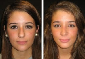 Patient-018a527125729c51c-rhinoplasty-for-women - Rhinoplasty For Women - Before And After | Fairfax and Manassas VA