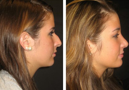 Patient-018c-rhinoplasty-for-women - Rhinoplasty For Women - Before And After | Fairfax and Manassas VA