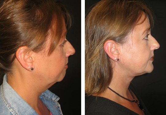 Patient-025-necklift - Neck Lift - Before And After | Fairfax and Manassas VA