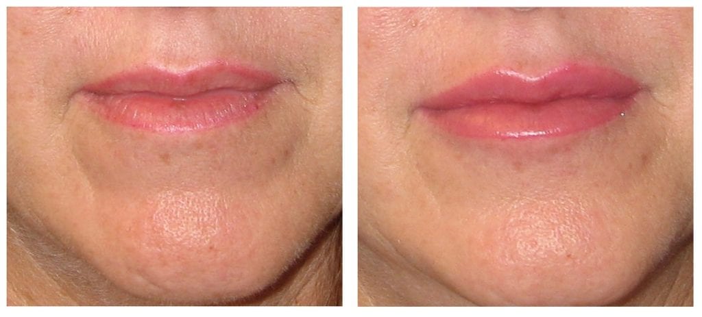 Restylane-lips-1-restylane - Restylane - Before And After | Fairfax VA