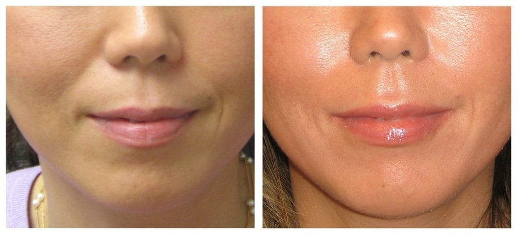 Restylane-lips-2-restylane - Restylane - Before And After | Fairfax and Manassas VA