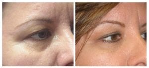 Restylane-under-eyes-new-restylane - Restylane - Before And After | Fairfax and Manassas VA