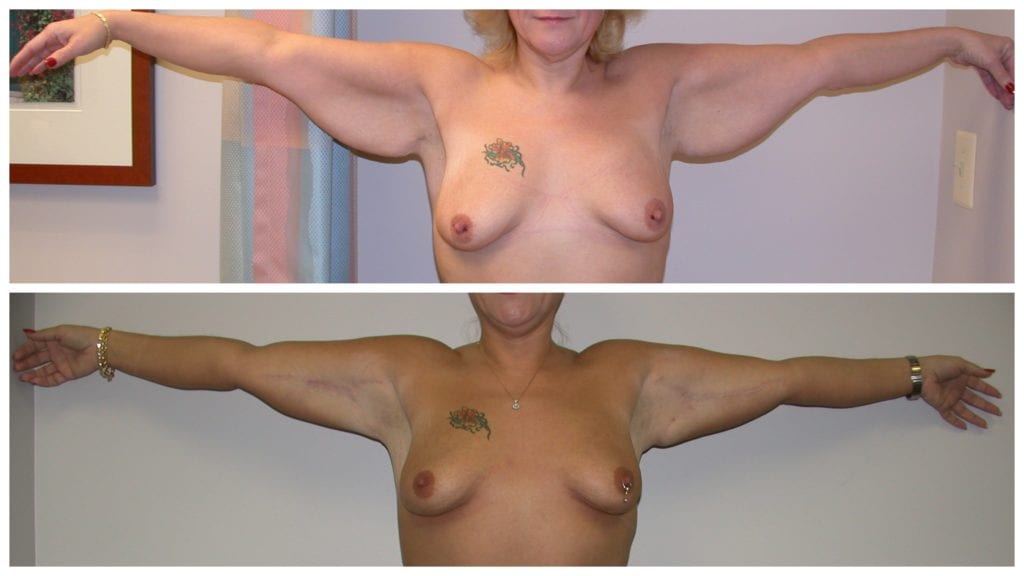 armlifts-New-patient-1-front-arm-lifts - Arm Lifts - Before And After - Fairfax and Manassas VA