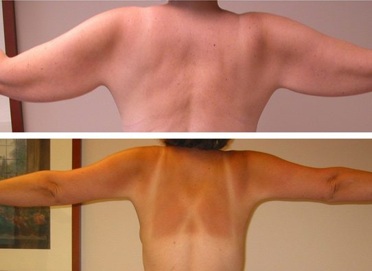 armlifts-New-patient-2nd-backview-arm-lifts - Arm Lifts - Before And After - Fairfax and Manassas VA