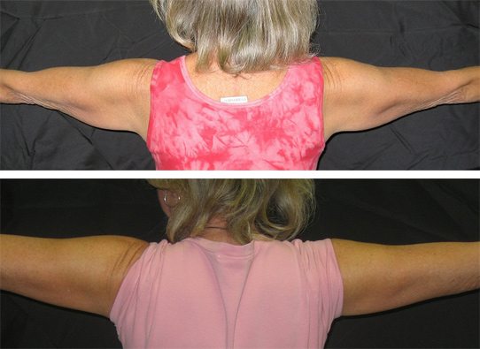 armlifts-New-patient-3-backview-arm-lifts - Arm Lifts - Before And After - Fairfax and Manassas VA