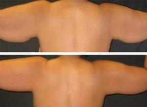 Arm Lifts - Before And After - Fairfax and Manassas VA