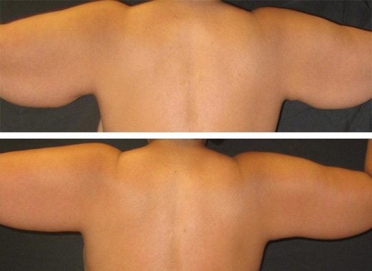 armlifts-New-patient-4-backview-arm-lifts - Arm Lifts - Before And After - Fairfax and Manassas VA