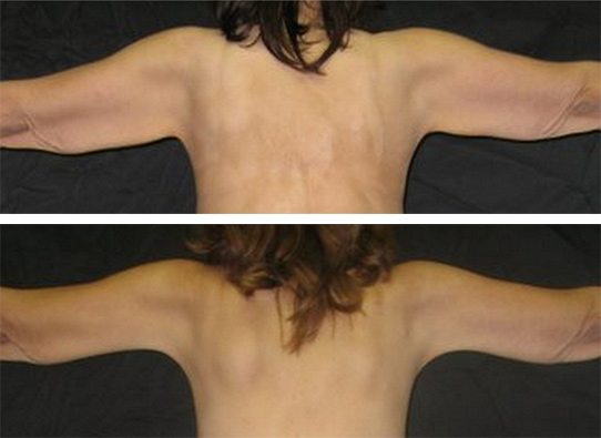 armlifts-New-patient-5-arm-lifts - Arm Lifts - Before And After - Fairfax and Manassas VA
