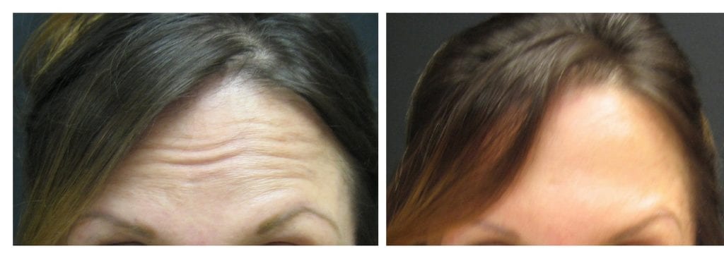botox-forehead1-botox - Botox - Before And After | Fairfax and Manassas VA