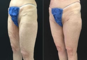 Thigh Lifts Before And After - Fairfax and Manassas VA