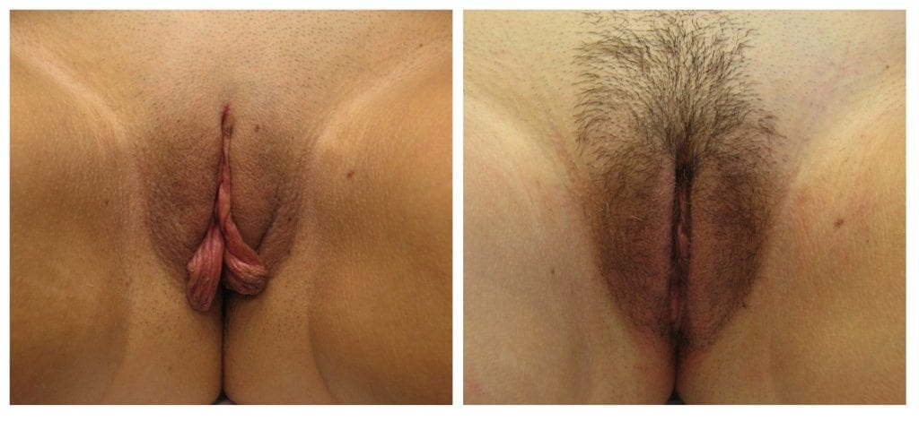 labiaplasty-New-Patient-3-labiaplasty - Labiaplasty - Before And After - Fairfax and Manassas VA