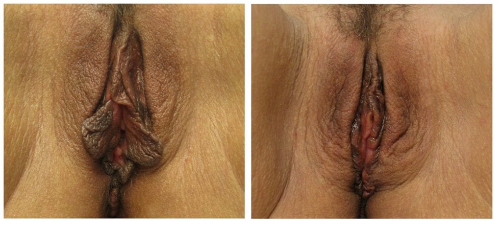 labiaplasty-New-patient-10-labiaplasty - Labiaplasty - Before And After - Fairfax and Manassas VA