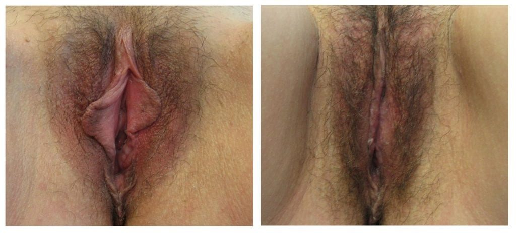 labiaplasty-New-patient-7-labiaplasty - Labiaplasty - Before And After - Fairfax and Manassas VA