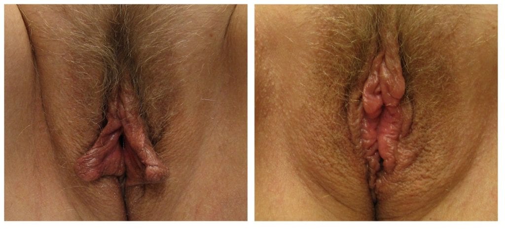 labiaplasty-New-patient-9-labiaplasty - Labiaplasty - Before And After - Fairfax and Manassas VA